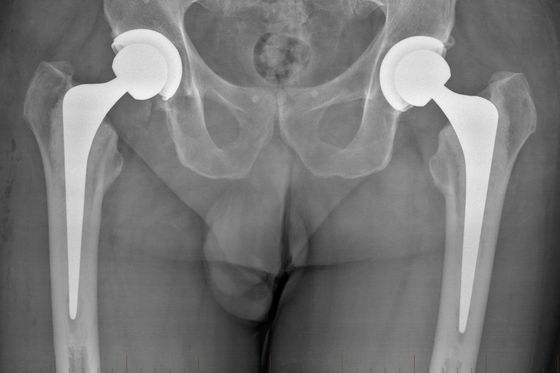 osteoarthritis hip replacement