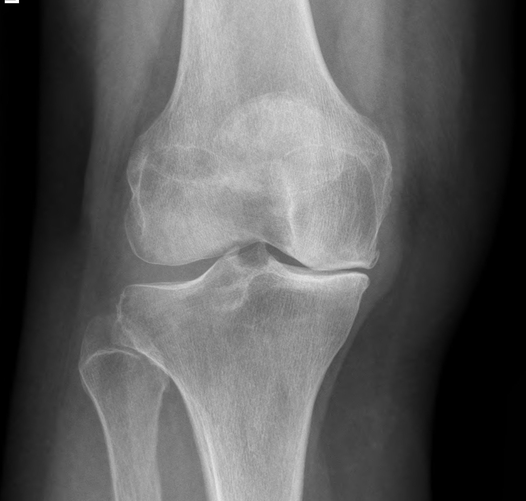 Partial Knee Replacement | Dr Simon Smith