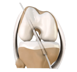 Diagram of an ACL reconstruction