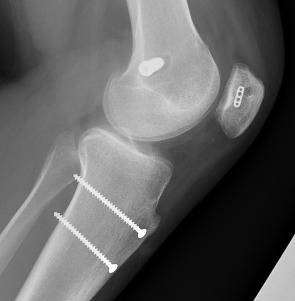 MRI scan of a left knee
