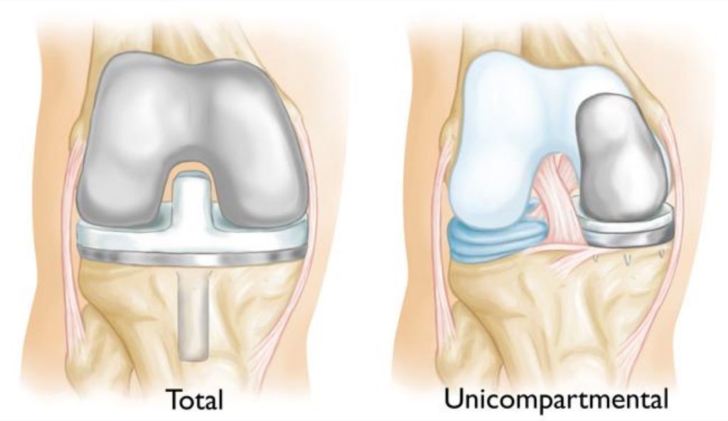 Diagram of a unicompartmental knee replacement