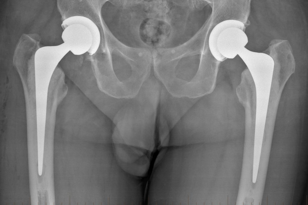 X-ray of both hips after hip replacement