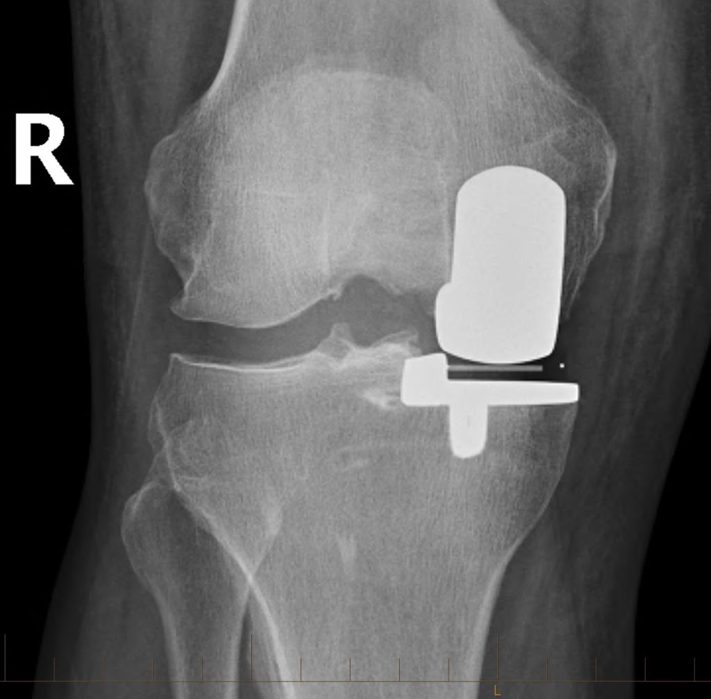 X-ray after partial knee replacement