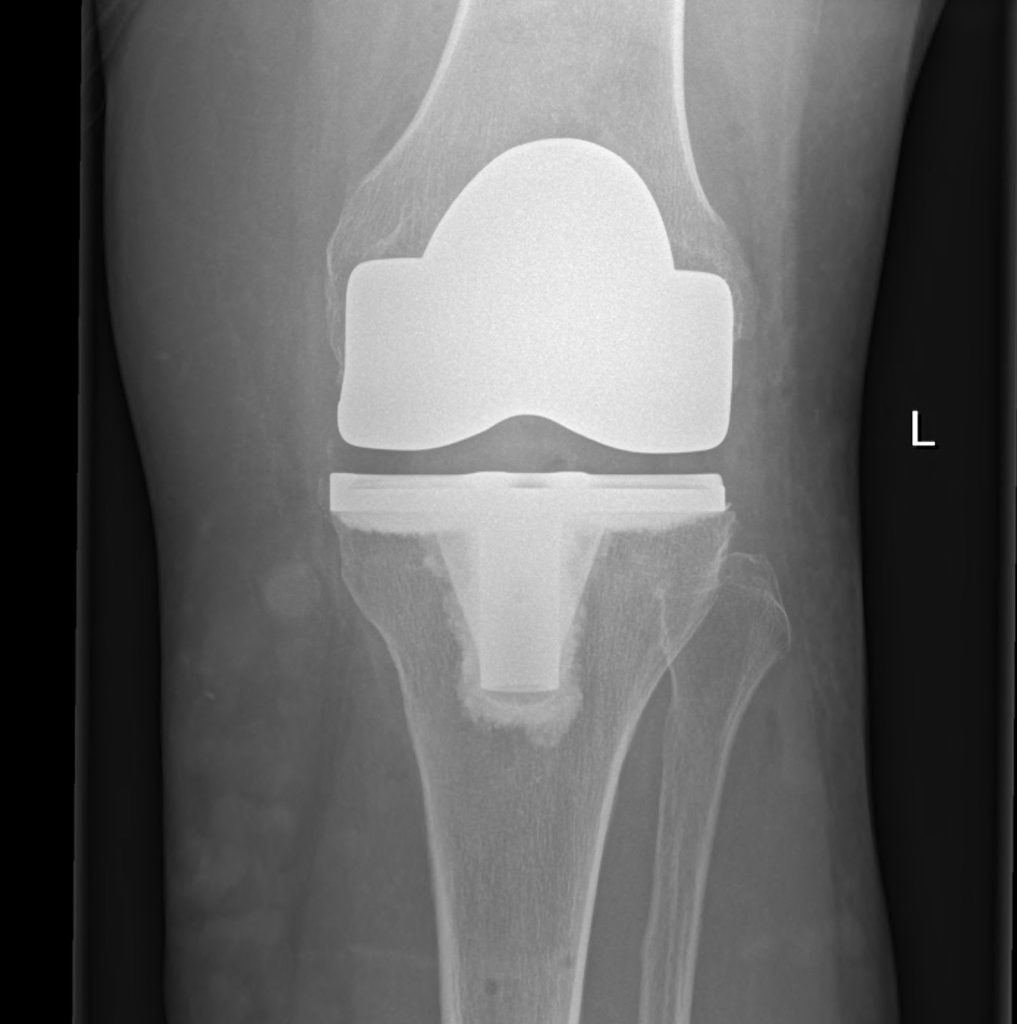 X-ray after total knee replacement