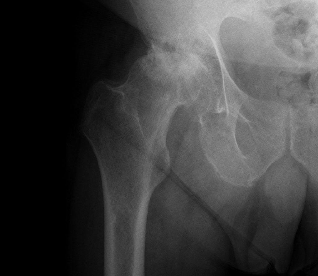 X-ray of an arthritic hip before surgery