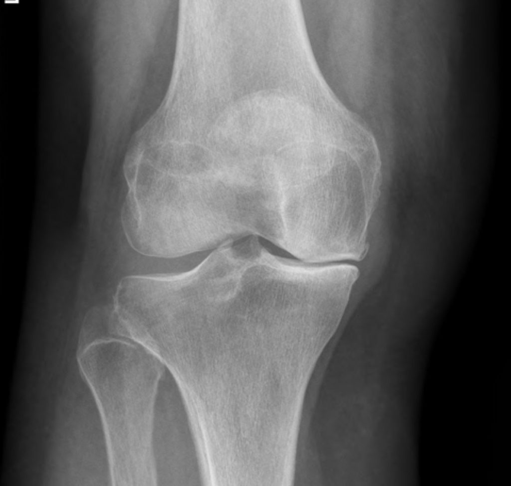 X-ray of a knee before partial knee replacement