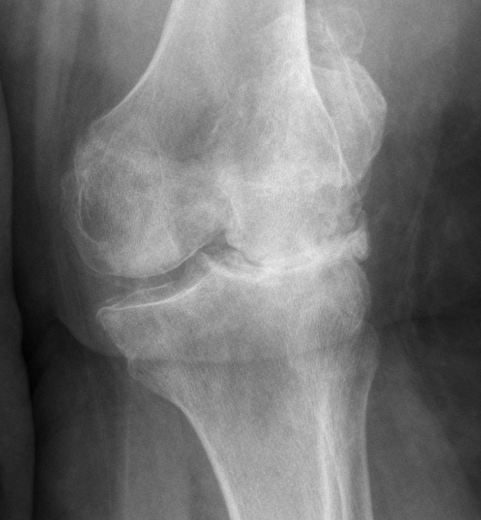 X-ray of an arthritic knee before total knee replacement